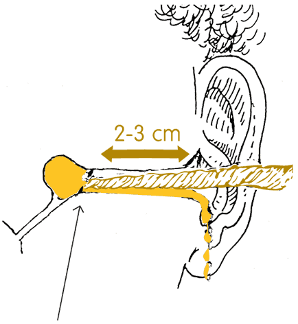 Diagram showing the correct position of 2 -3 cm into the ear for the tissue spear.