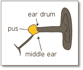 Diagram of the human ear. The middle ear is blocked by pus.
