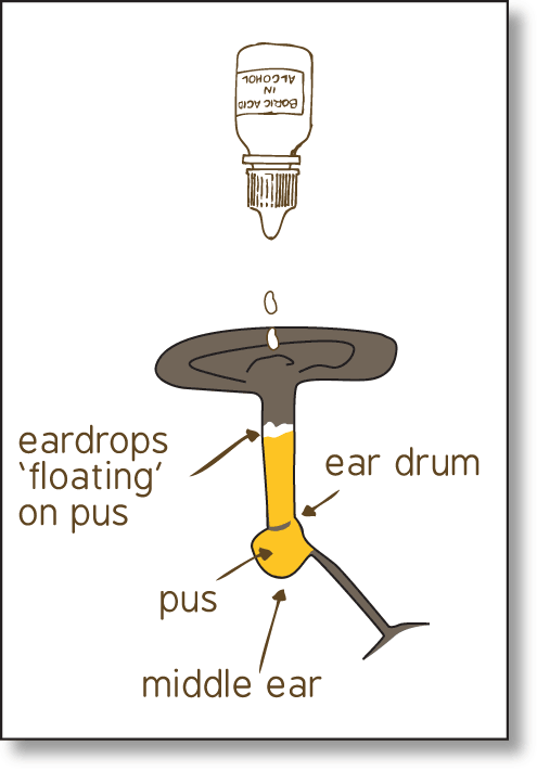 Diagram of the human ear. The middle ear is blocked by pus and the eardrops cannot get behind it into the eardrum.