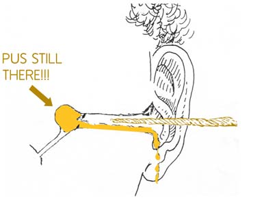 Diagram showing a tissue spear that is not in far enough in the ear - it cannot reach the pus.