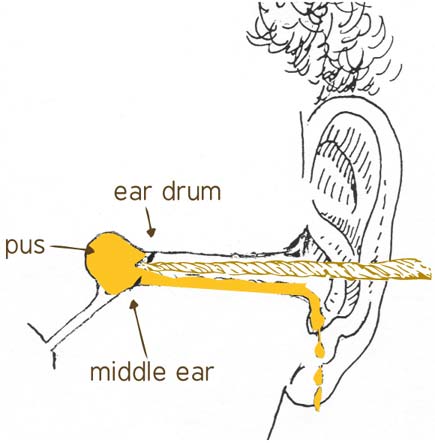 Diagram showing the correct position for the tissue spear in the ear