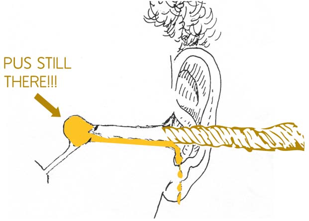 Diagram showing a tissue spear that is too big - it gets stuck and cannot reach the pus in the middle ear.